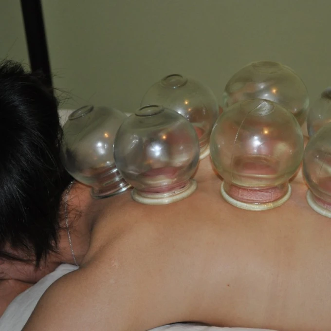 Cuppingmassage
